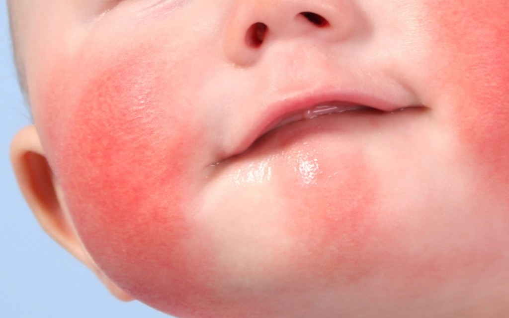Аллергия на мед у ребенка