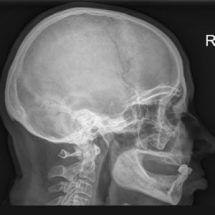 Рентген (рентгенография) височных костей