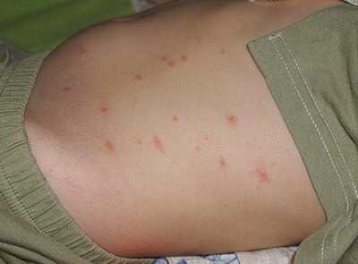 Аллергия на мед лечение