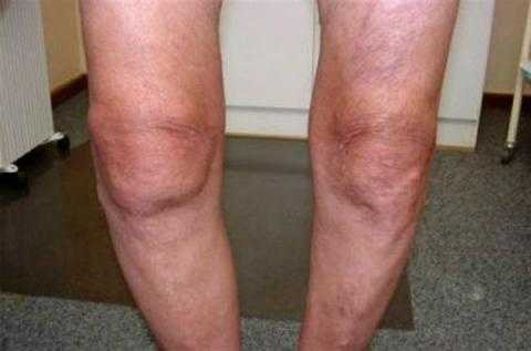 Лечение коленного сустава медом